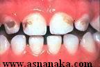 Inhabit teeth ached in cases of emergency