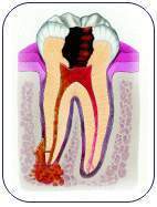 Inhabit teeth ached in cases of emergency