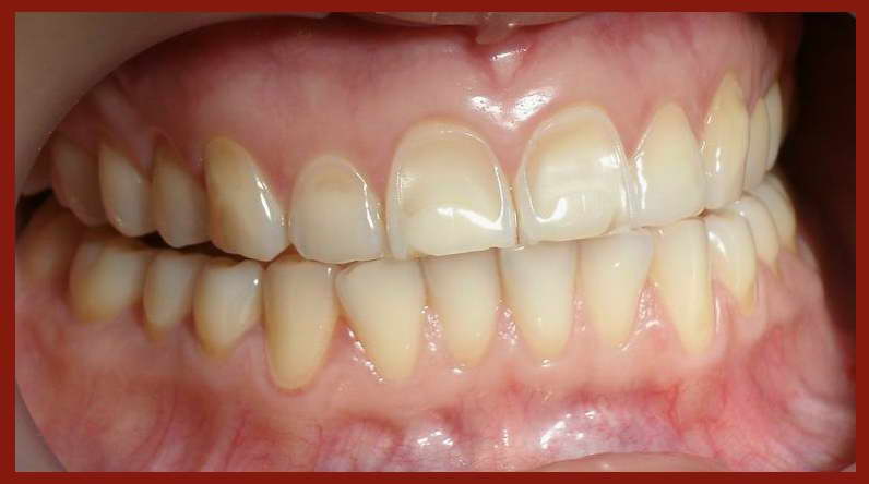 لفقدان الأسنان علاقة أمراض الكلى