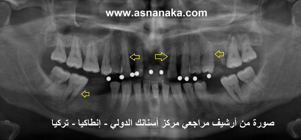 الأسنان العواقب والمشاكل وكيفية علاجها