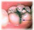 Inhabit teeth ached in cases of emergency