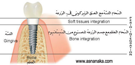   zirconimplant.jpg