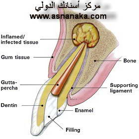 هل تعلم أن مشاكل الأسنان تسبب مرض السكري ... كيف ؟