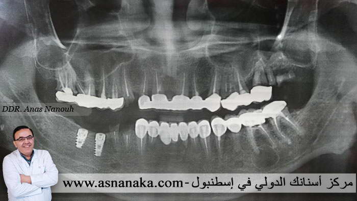 تكملة علاجع مراجع بطرق أخرى غير الزرع بعد أن أقنعوه بقلع جميع الأسنان في مصر منتدى أسنانك