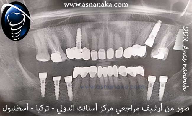 صورة شعاعية تبين مكان الزرعات التي تم زرعها من نوع TBR ذات العنق الزيركونية 